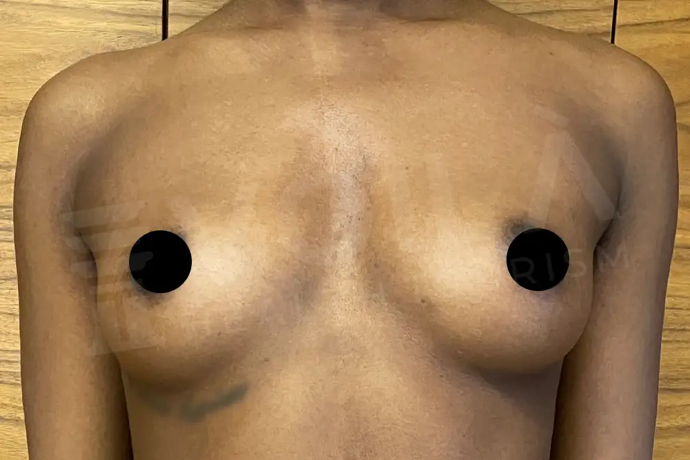 Breast Implant - Voila health tourism - dr furkan certel