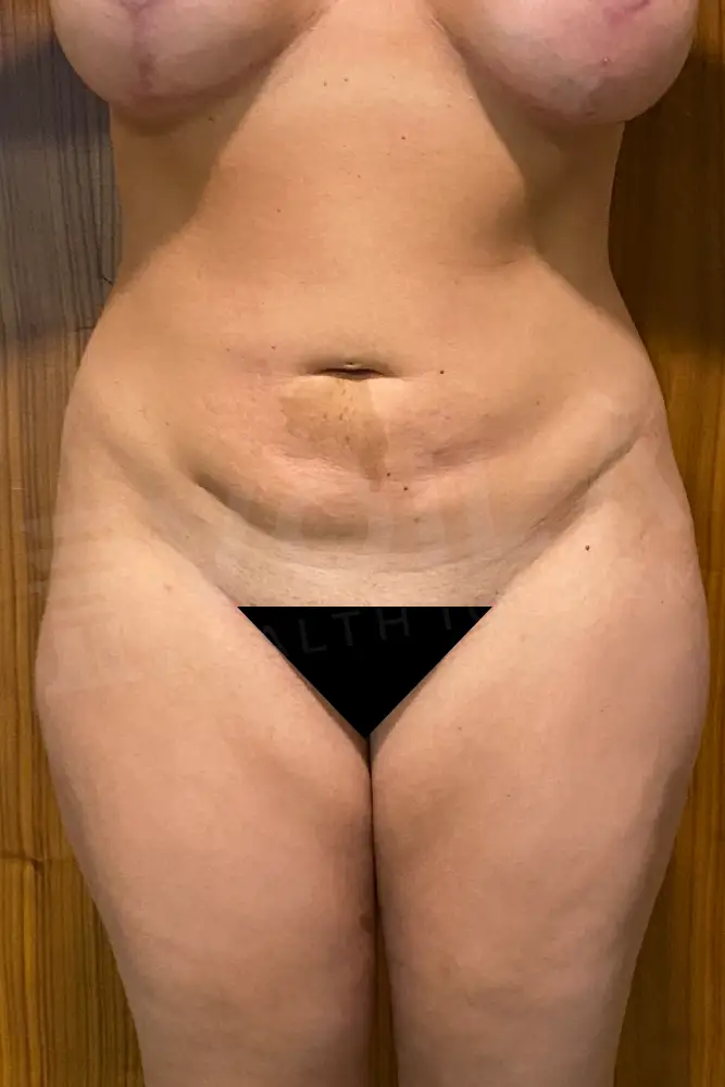 Liposuction - Voila health tourism - dr furkan certel