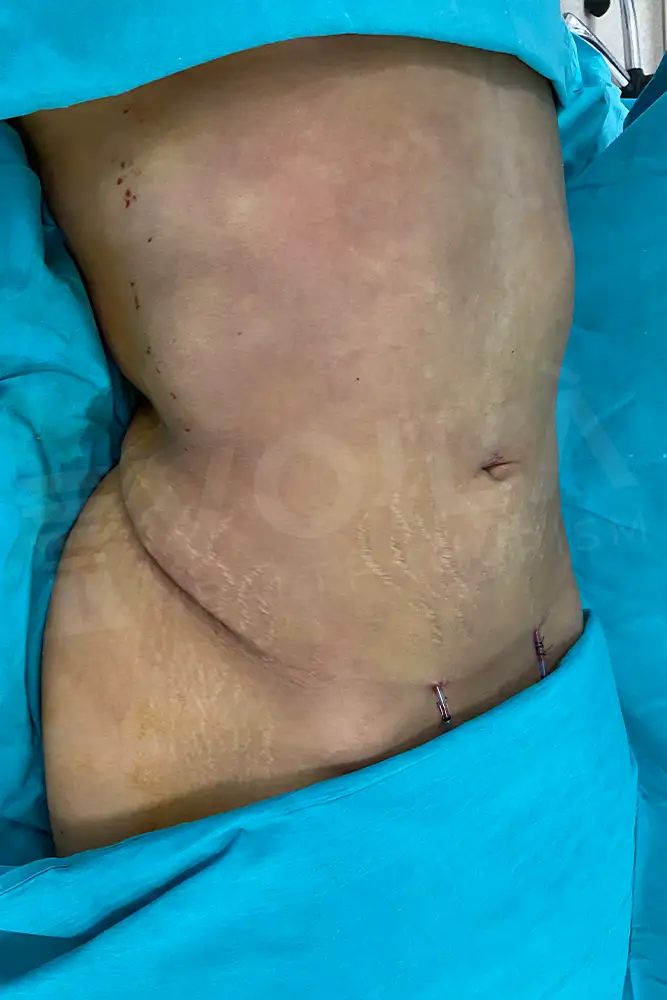 Liposuction - Voila health tourism - dr furkan certel