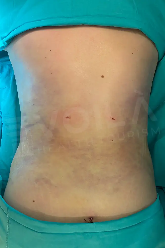 Liposuction - Voila health tourism - dr furkan certel
