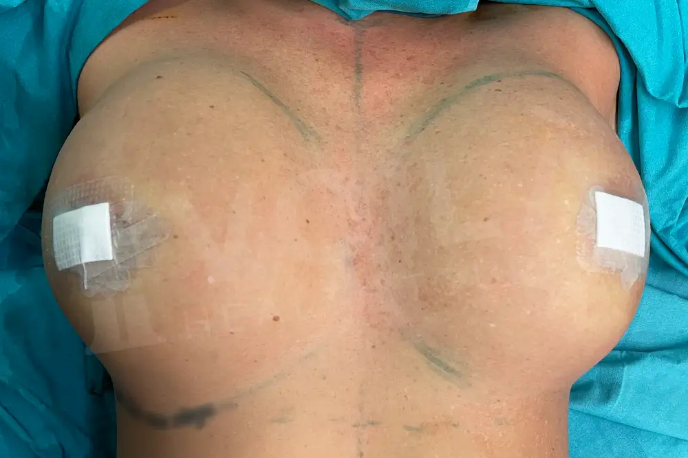 Breast Implant - Voila health tourism - dr furkan certel