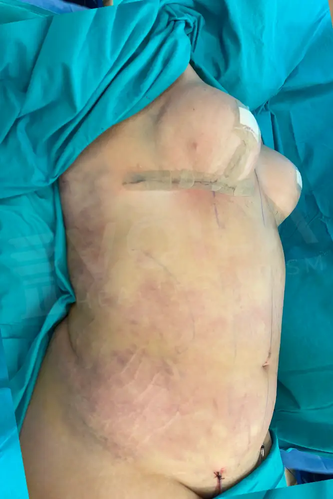 Liposuction - Voila health tourism - dr furkan certel