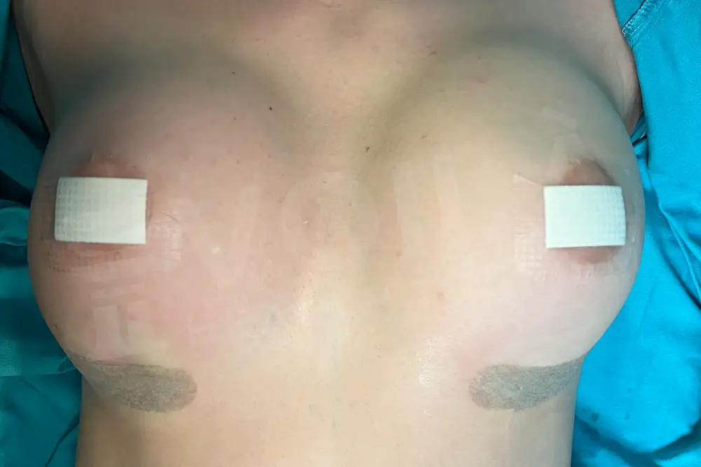 Breast Implant - Voila health tourism - dr furkan certel
