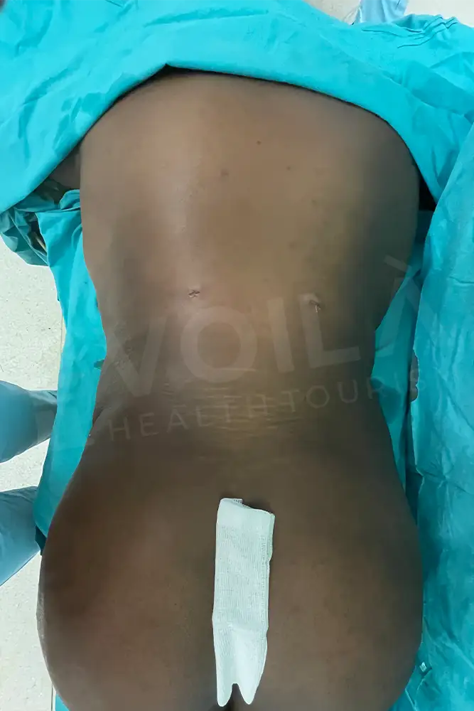 Liposuction - Voila health tourism - dr furkan certel
