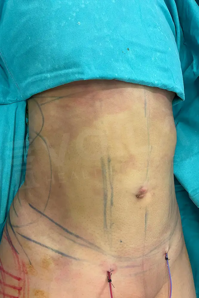 Liposuction - Voila health tourism - dr furkan certel