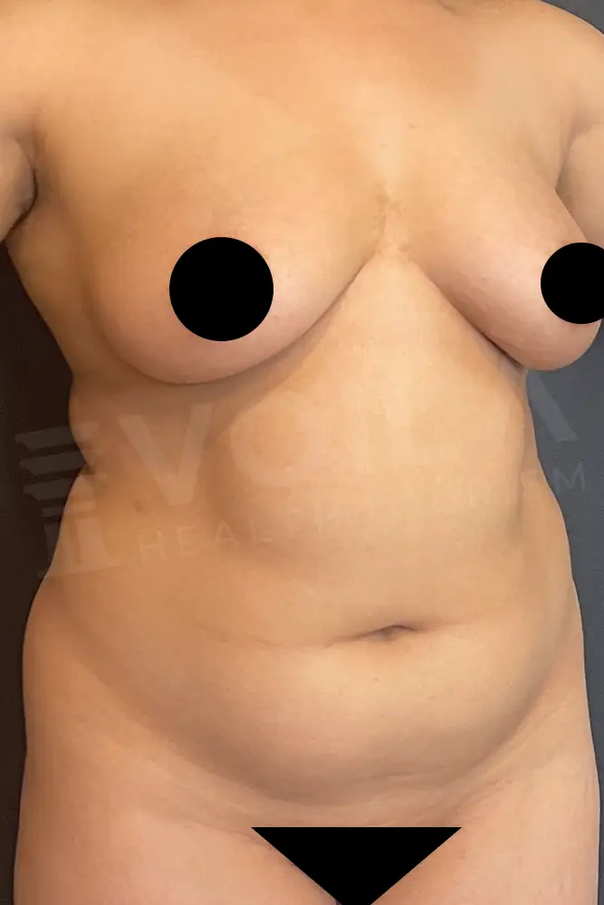 Liposuction - Voila health tourism - dr furkan certel