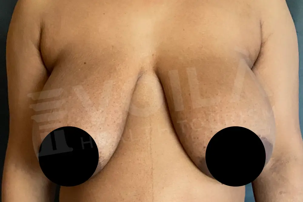 Breast Lift - - Voila health tourism - dr furkan certel
