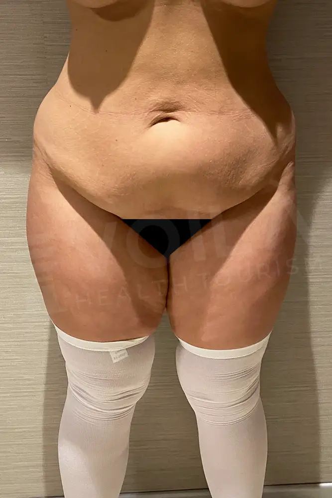 Leg Liposuction - Voila Clinic