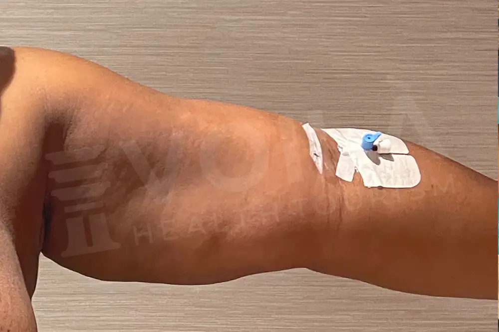 Arm Lift - Voila Health Tourism - Dr Furkan Certel