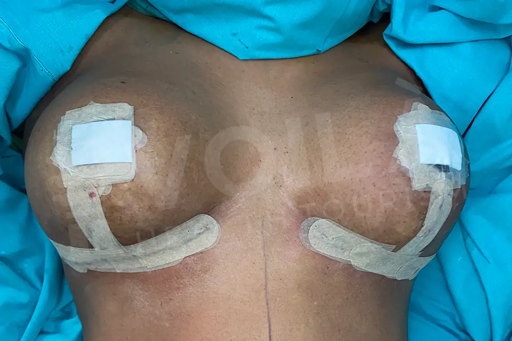 Breast Lift - - Voila health tourism - dr furkan certel