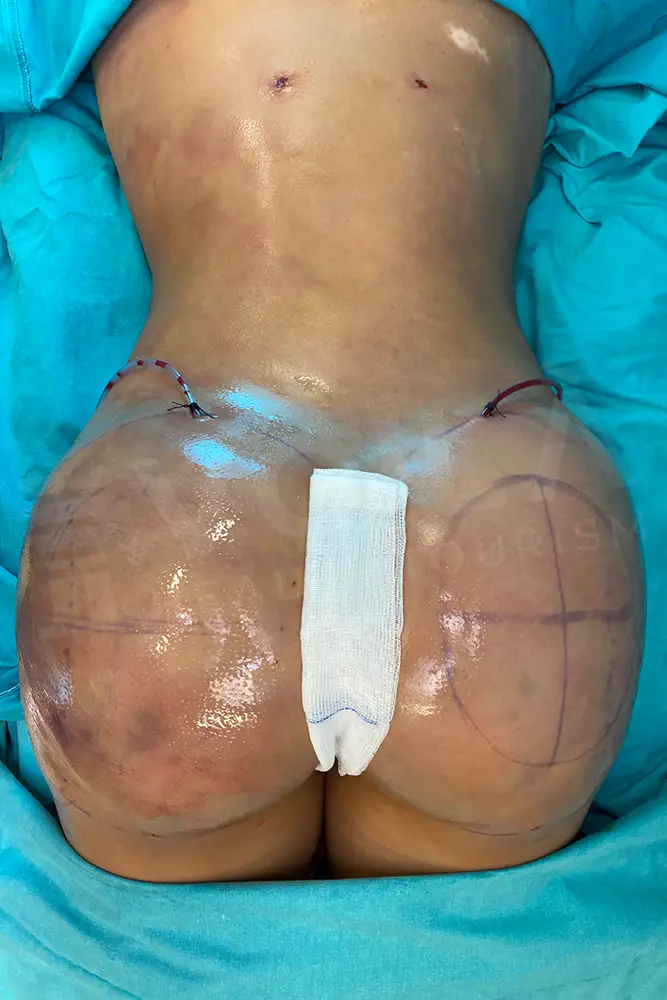 Supercharged BBL - Dr Furkan Certel - Voila Clinic