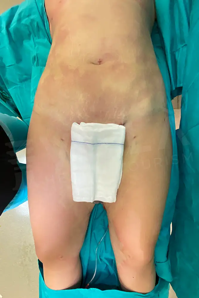 Leg Liposuction - Voila Clinic