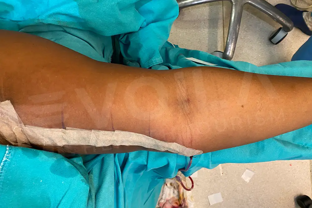 Arm Lift - Voila Health Tourism - Dr Furkan Certel
