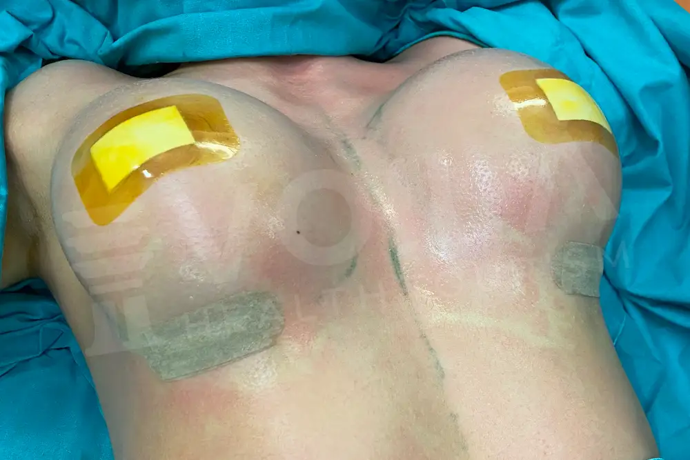Breast Implant - Voila health tourism - dr furkan certel
