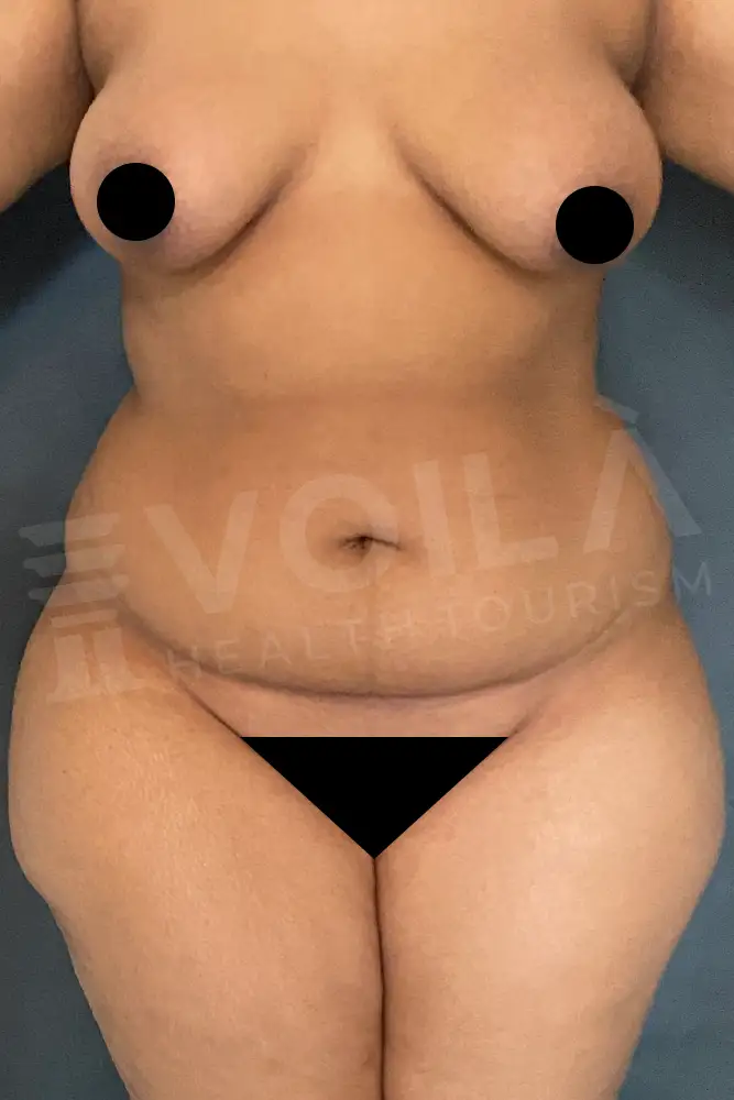 Liposuction - Voila Health Tourism - Dr Furkan Certel