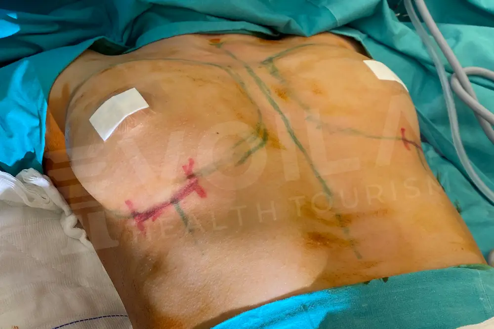 Breast Implant - Voila health tourism - dr furkan certel