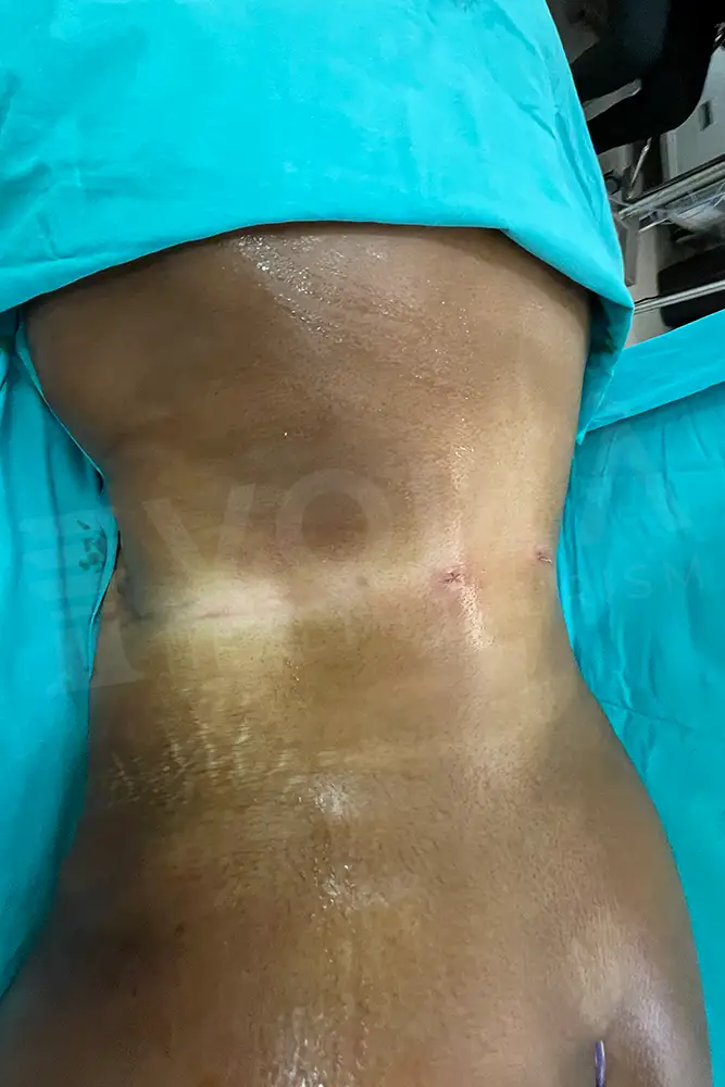 Liposuction - Voila health tourism - dr furkan certel