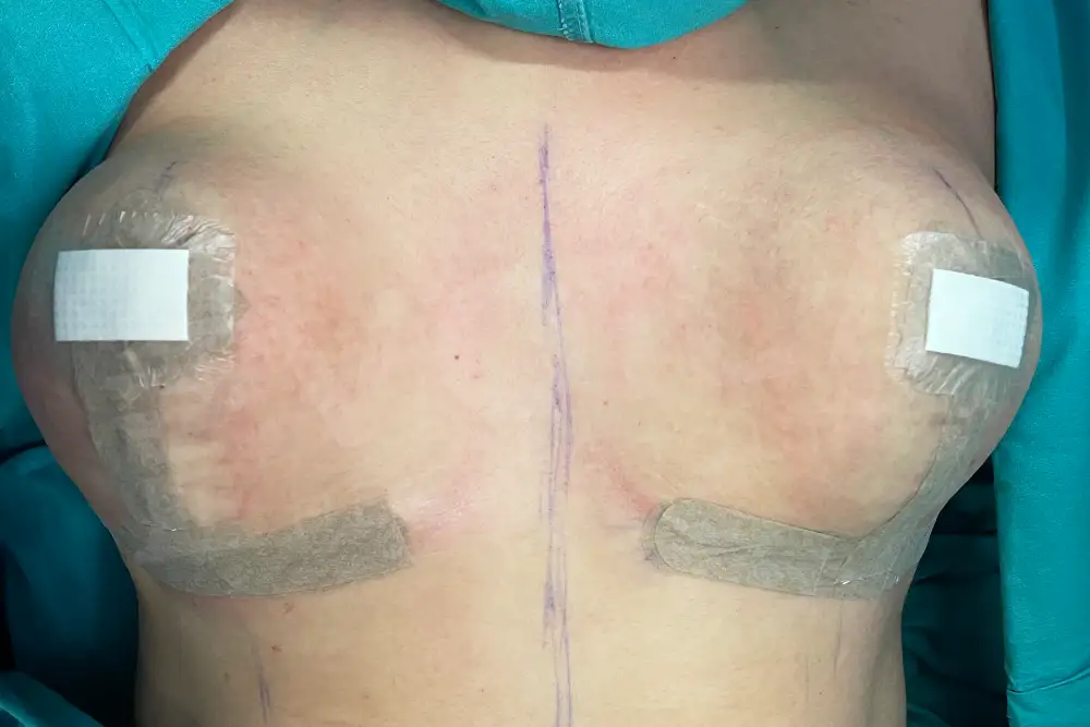 Breast Lift - Voila health tourism - dr furkan certel