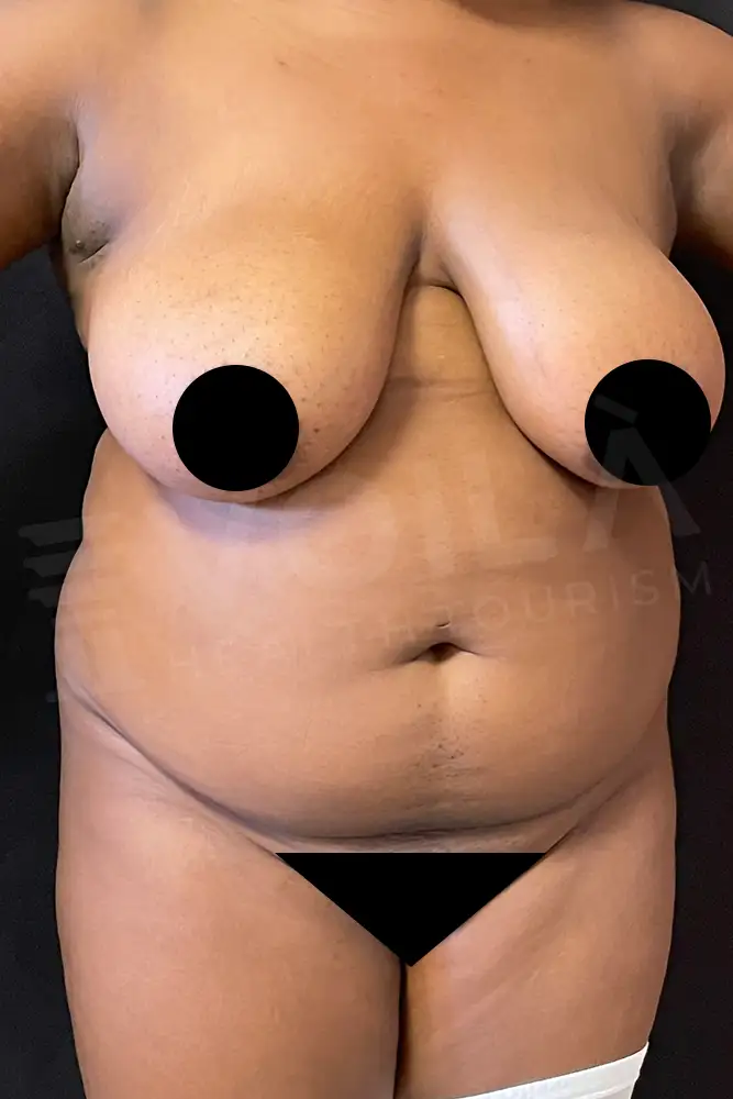 Liposuction - Voila health tourism - dr furkan certel