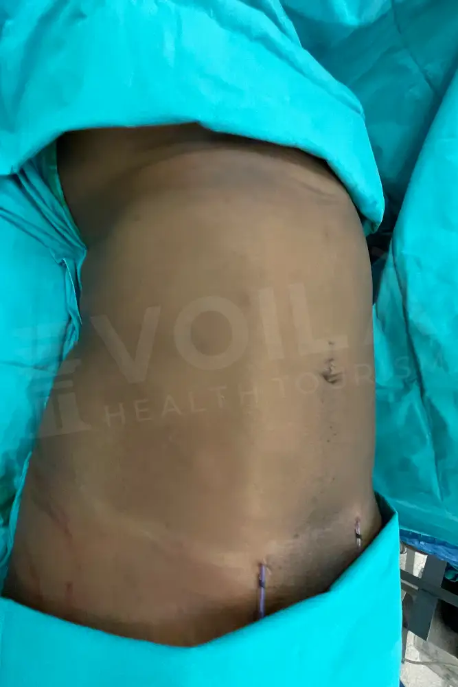Liposuction - Voila health tourism - dr furkan certel