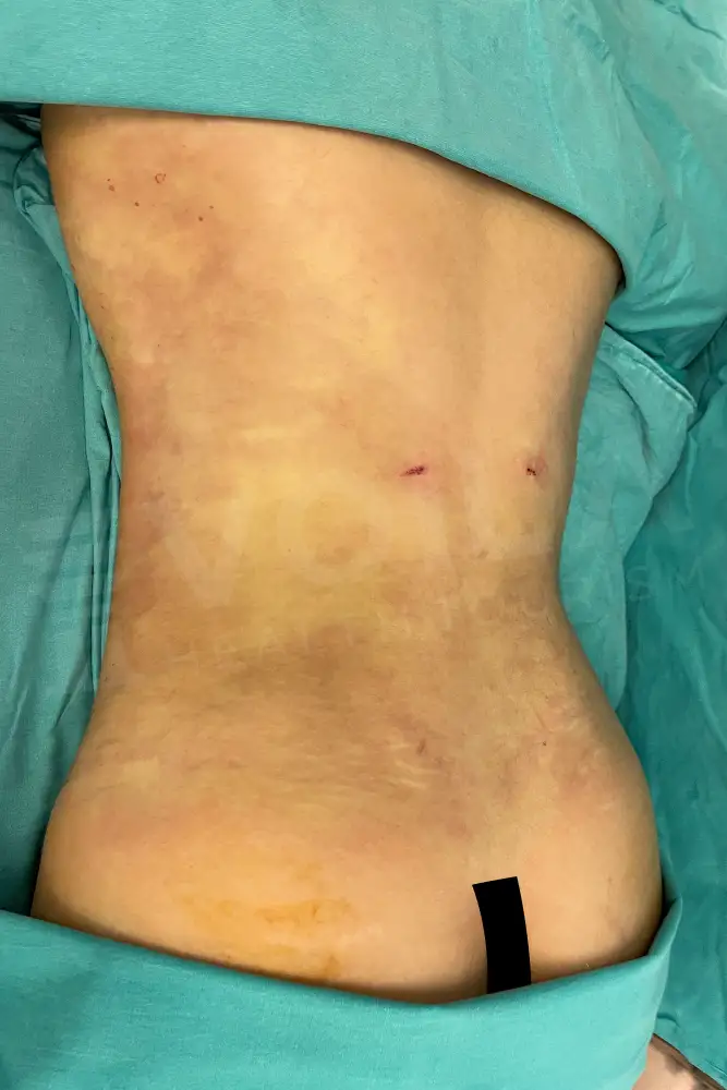 Liposuction - Voila health tourism - dr furkan certel