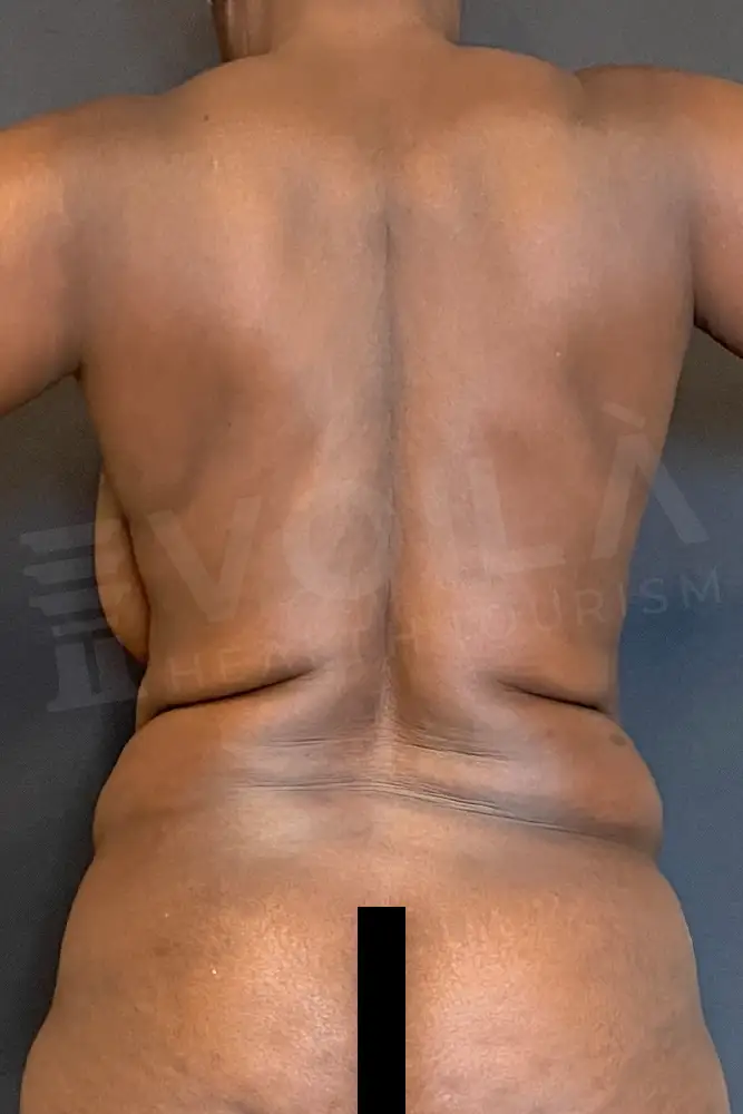 Liposuction - Voila health tourism - dr furkan certel