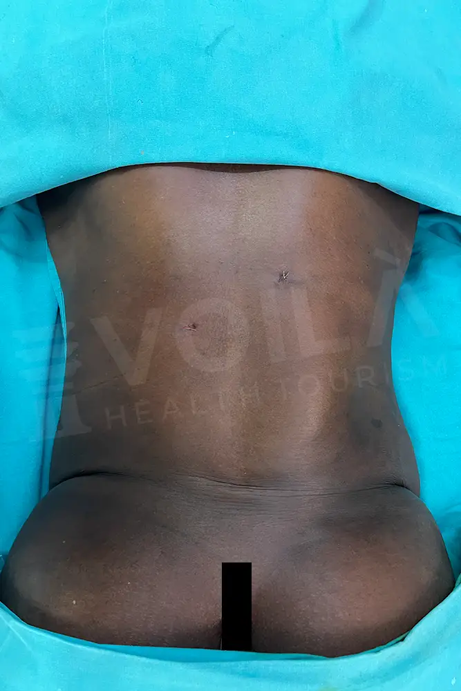 Liposuction - Voila health tourism - dr furkan certel