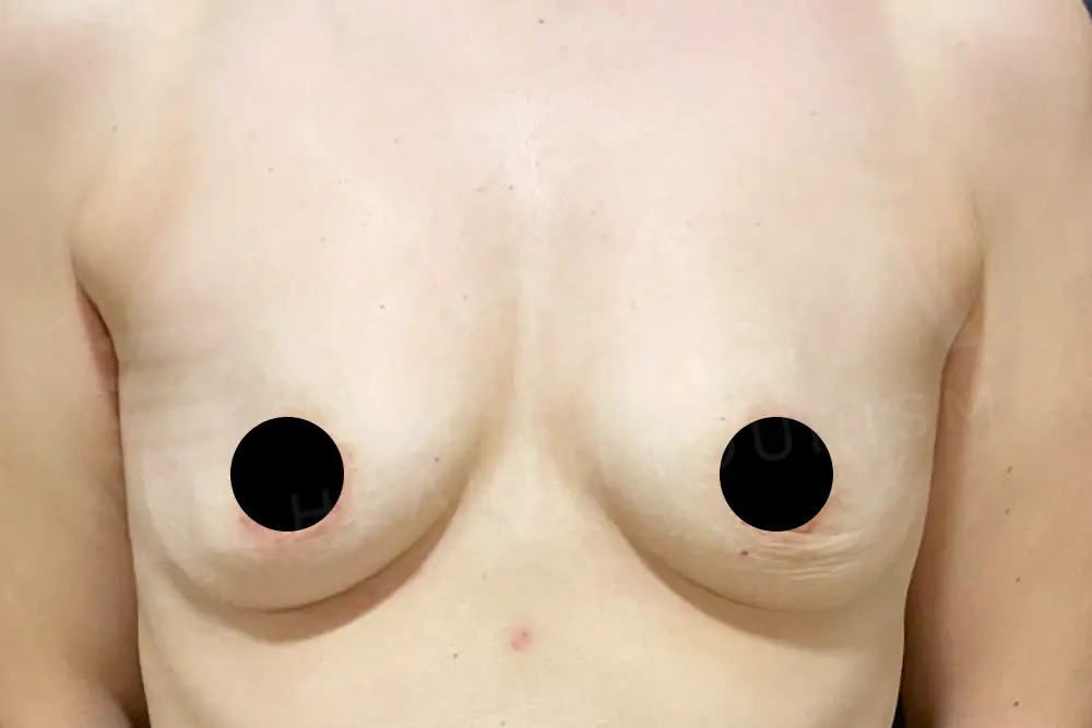 Breast Implant - Voila health tourism - dr furkan certel