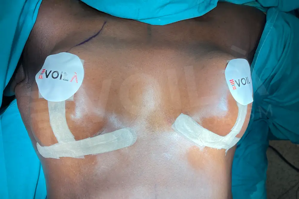 Breast Lift - Voila health tourism - dr furkan certel