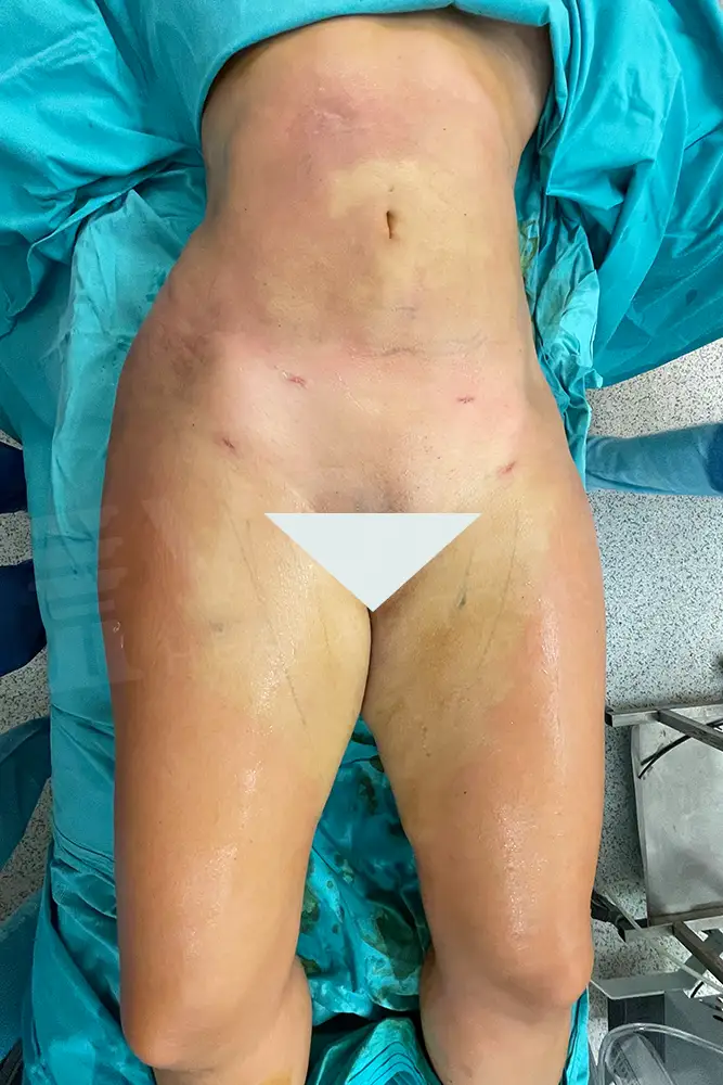 Liposuction - Voila health tourism - dr furkan certel