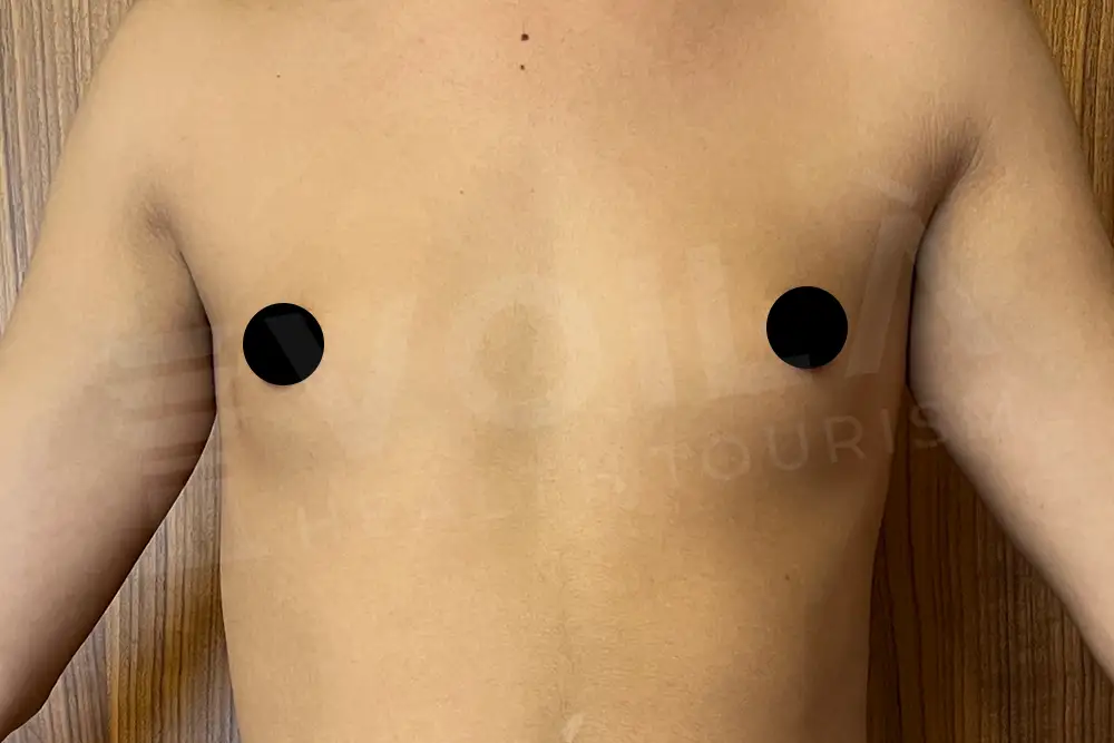 Breast Implant - Voila health tourism - dr furkan certel