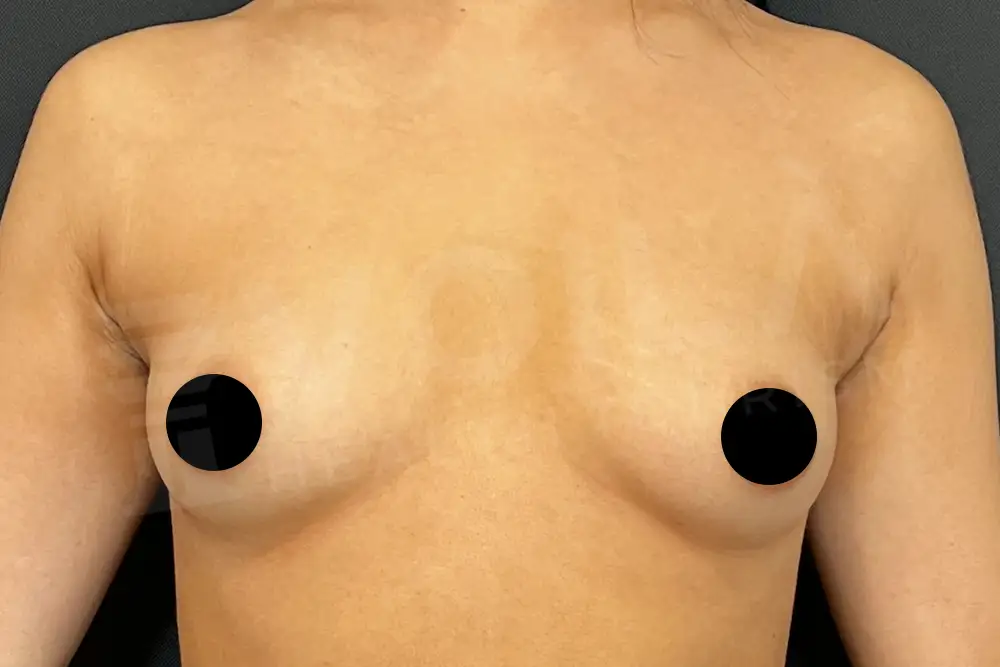 Breast Implant - Voila health tourism - dr furkan certel