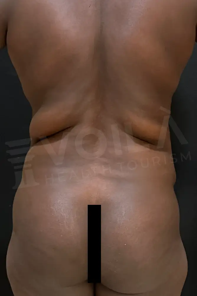 Liposuction - Voila health tourism - dr furkan certel
