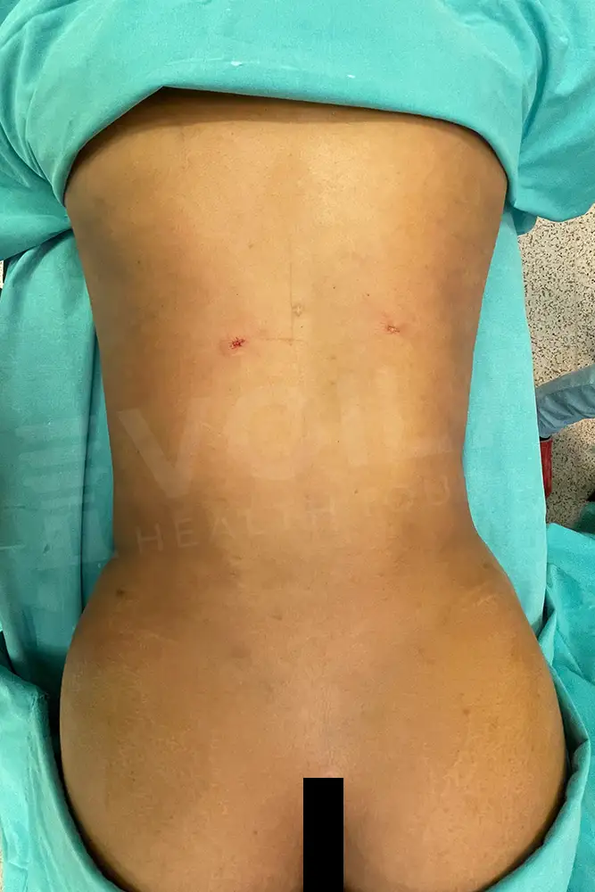 Liposuction - Voila health tourism - dr furkan certel