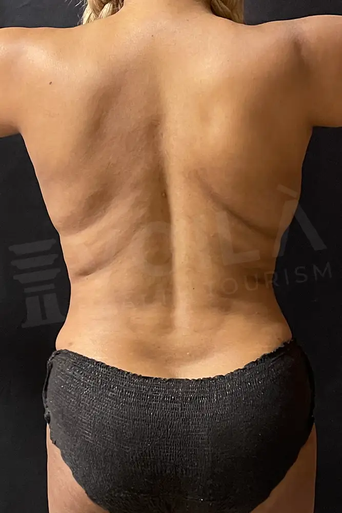 Liposuction - Voila health tourism - dr furkan certel