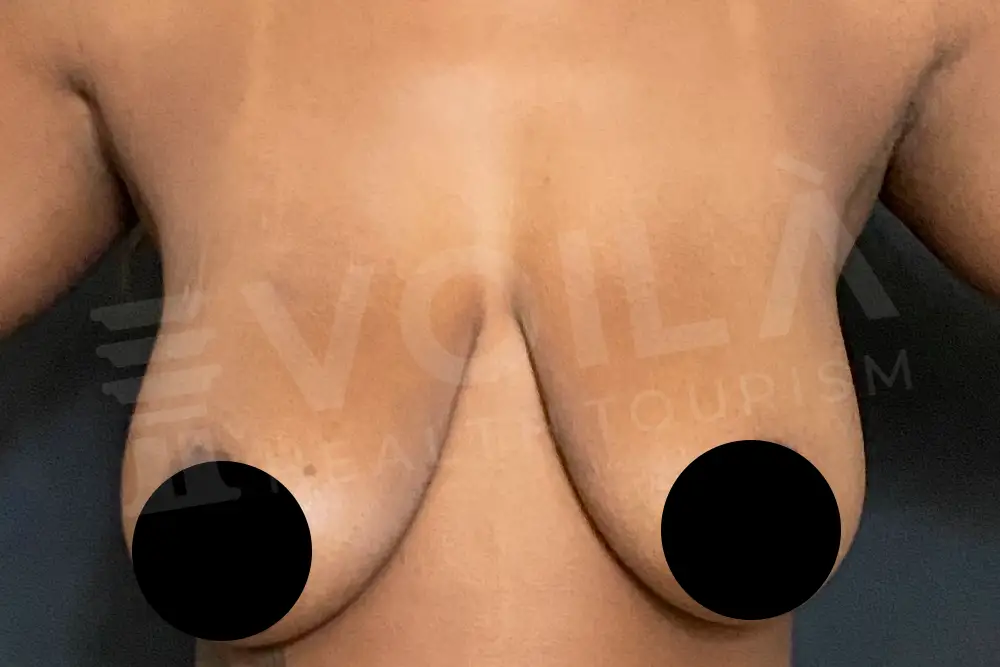 Breast Lift - - Voila health tourism - dr furkan certel