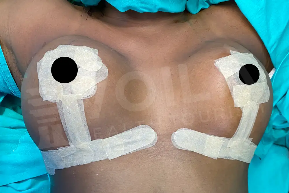 Breast Lift - - Voila health tourism - dr furkan certel