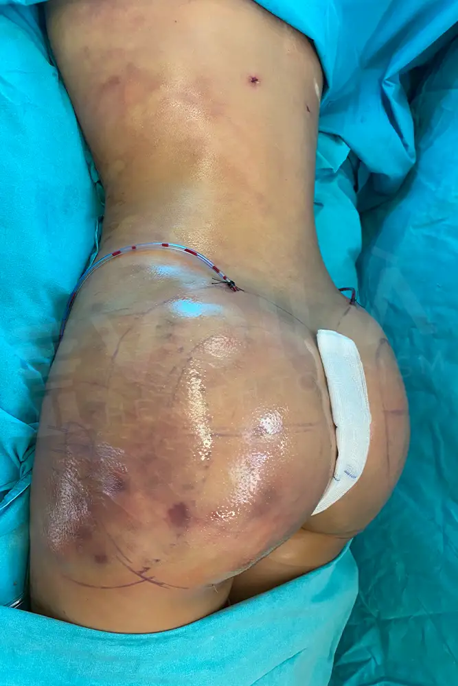 Supercharged BBL - Dr Furkan Certel - Voila Clinic