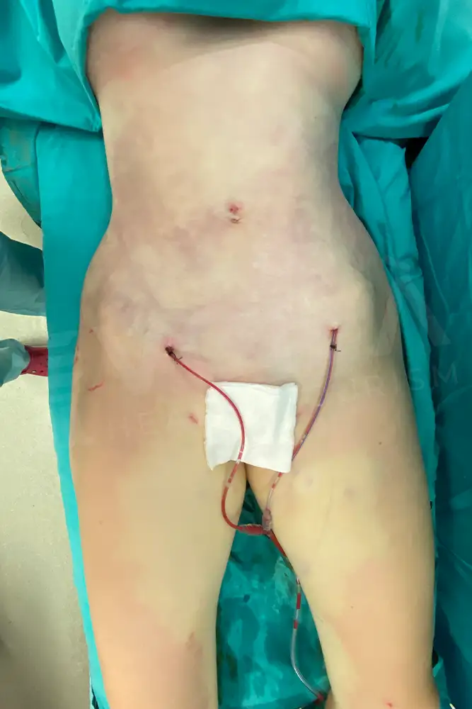 Leg Liposuction - Voila Clinic