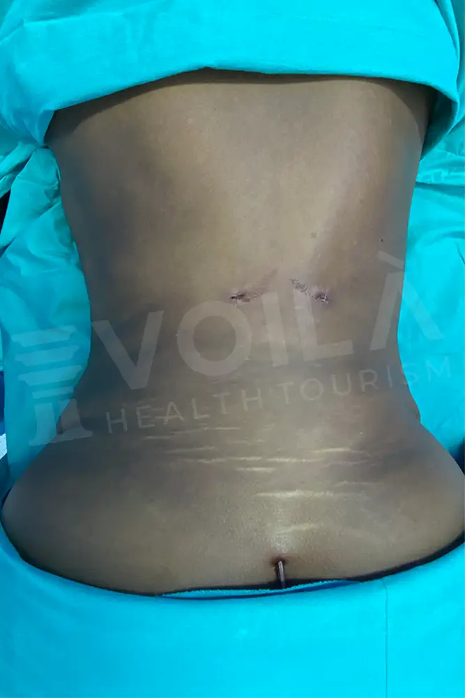 Liposuction - Voila Health Tourism - Dr Furkan Certel