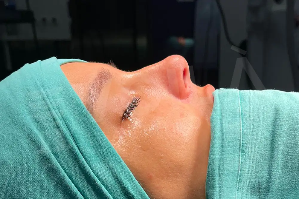Rinoplasty - Voila health tourism - dr furkan certel