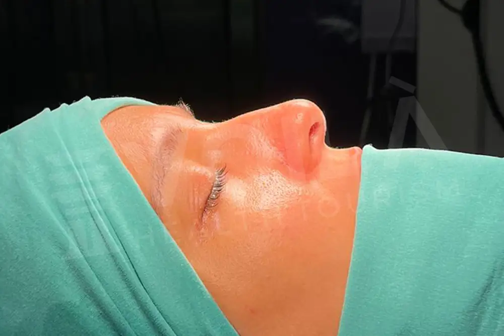 Rinoplasty - Voila health tourism - dr furkan certel