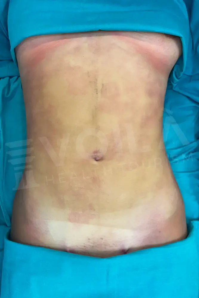 Liposuction - Voila health tourism - dr furkan certel