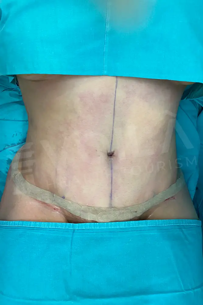 Tummy Tuck - Voila Health Tourism - Dr Furkan Certel
