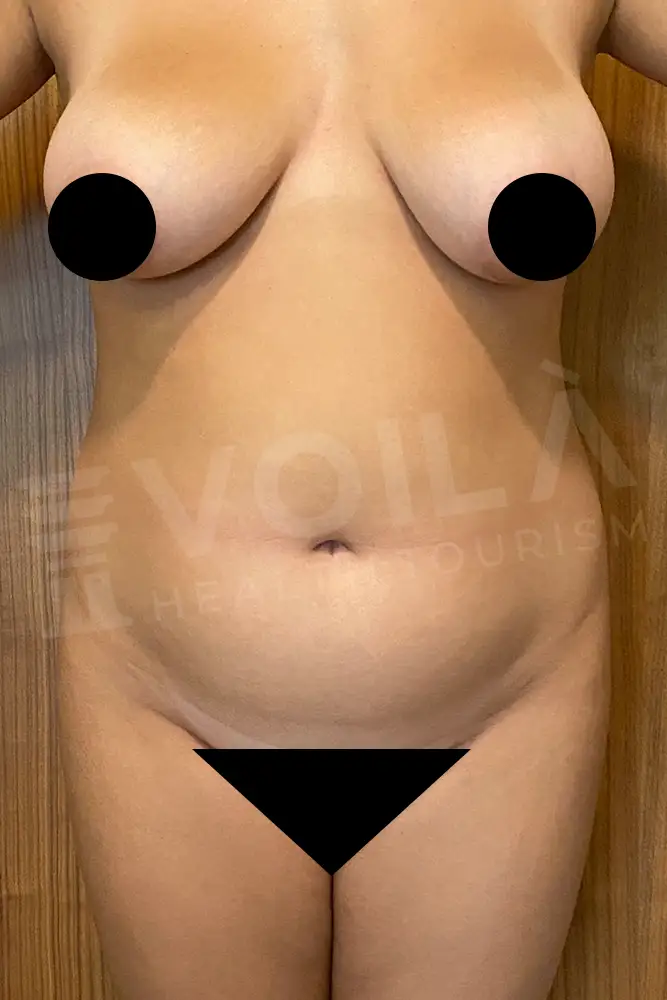 Liposuction - Voila health tourism - dr furkan certel
