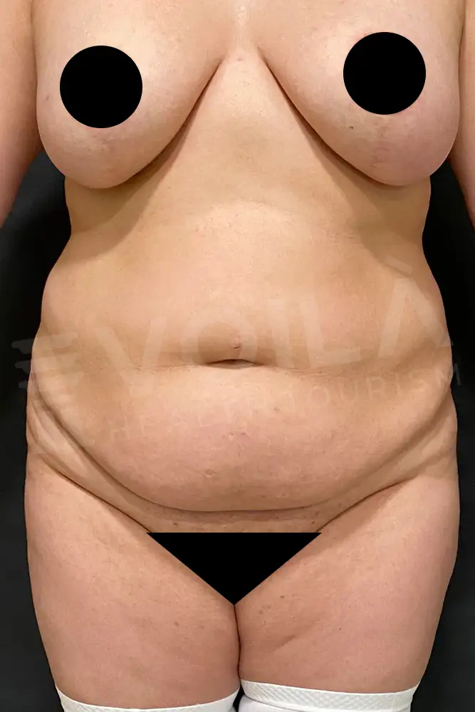 Tummy Tuck - Voila Health Tourism - Dr Furkan Certel