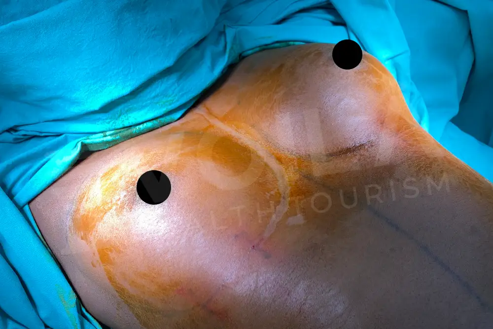 Breast Implant - Voila health tourism - dr furkan certel