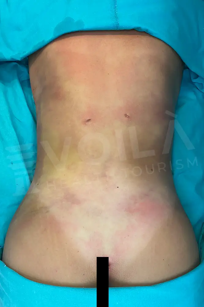 Liposuction - Voila health tourism - dr furkan certel