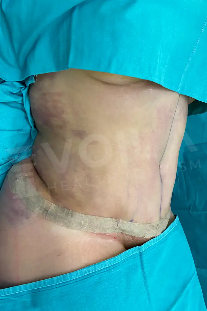 Tummy Tuck - Voila Health Tourism - Dr Furkan Certel