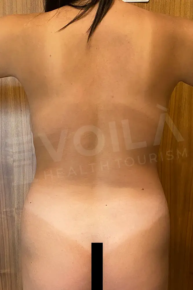 Liposuction - Voila health tourism - dr furkan certel